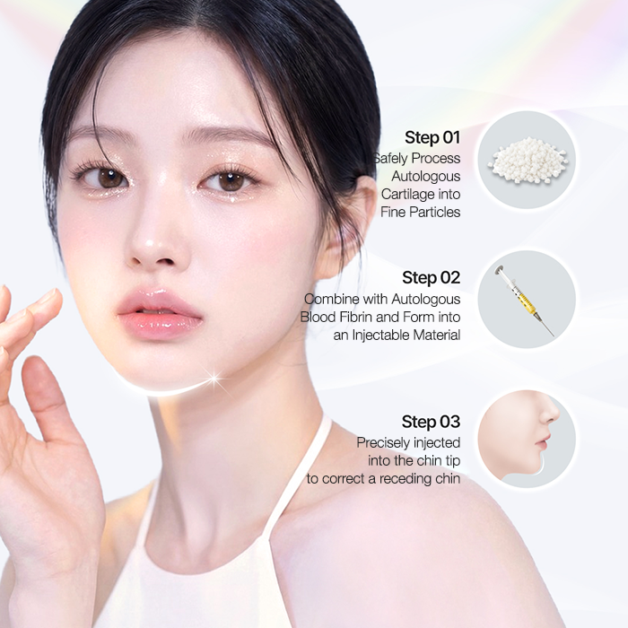 Cartilage-Particle Chin-Tip Injection